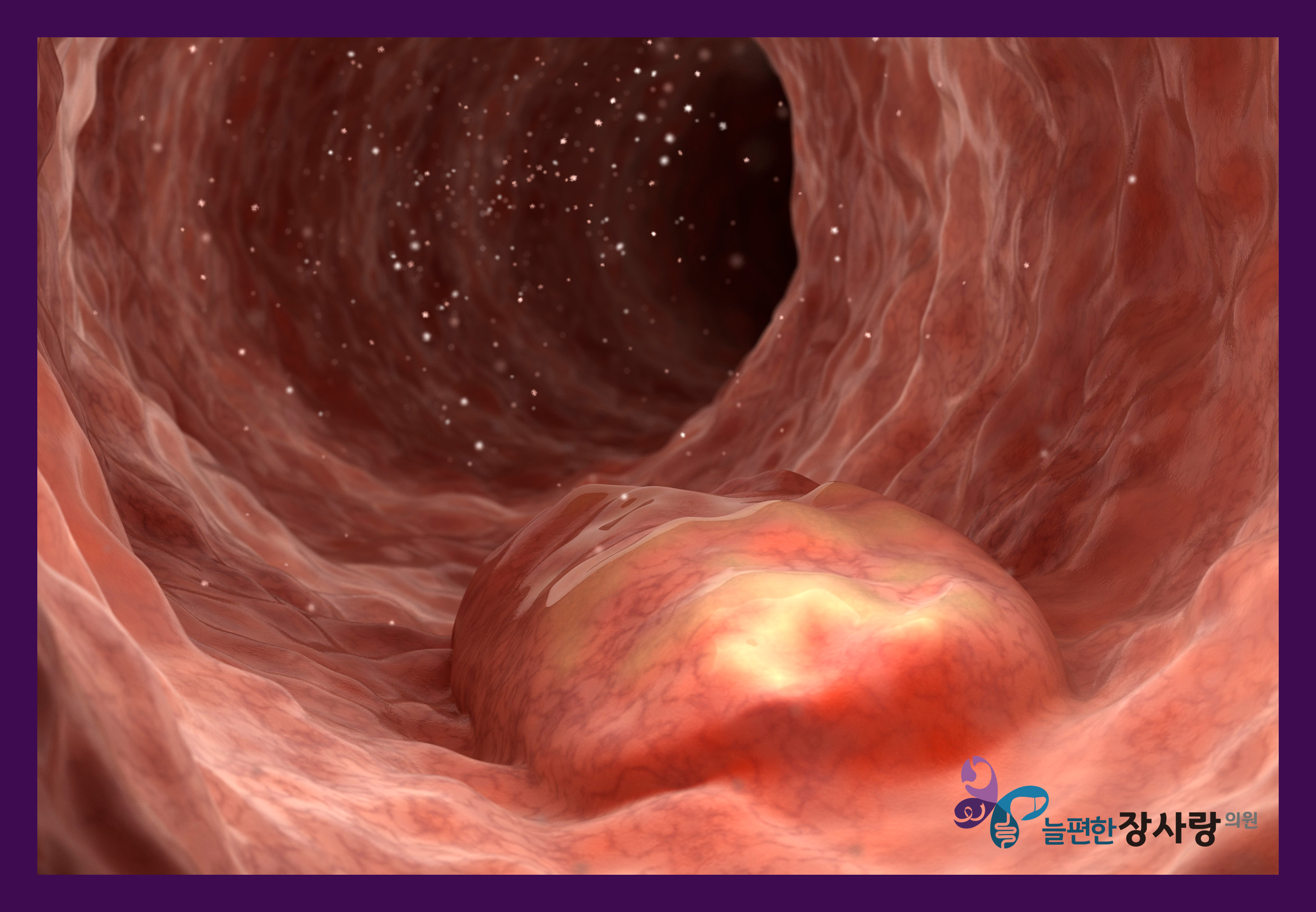 청주대장내시경 왜 필요한 검사일까요